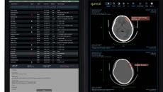 Desktop view of the Qure.ai Stroke Management Platform
